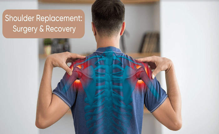 Shoulder Replacement: Surgery & Recovery Shoulder ReplacementSurgery Recovery