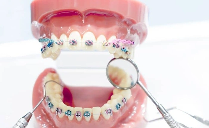 Deciphering Orthodontics: Clear Aligners vs. Traditional Braces Explained Deciphering Orthodontics